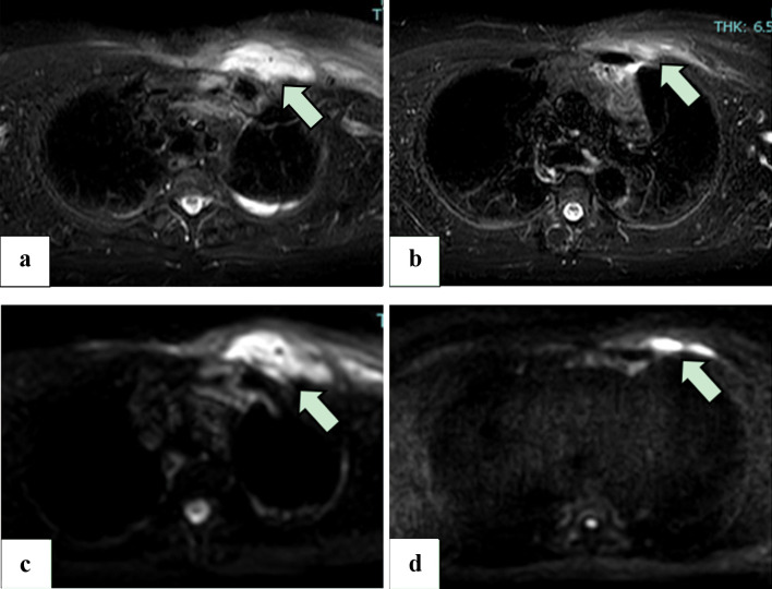 Rapidly-Progressing Pyomyositis After Chest Contusion in a Patient With Well-Controlled Diabetes Mellitus.