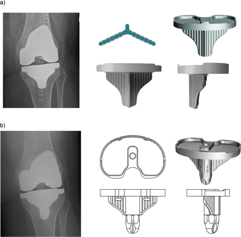 Total knee arthroplasty in patients with severe obesity: outcomes of standard keeled tibial components versus stemmed universal base plates.