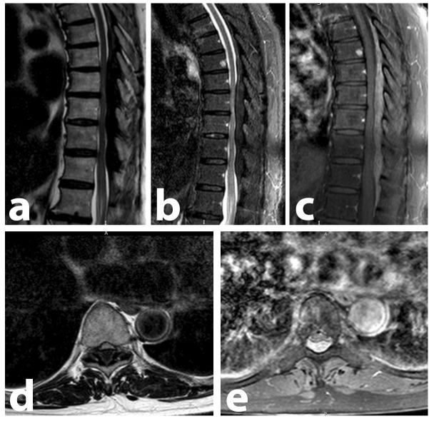 Epidural Extramedullary Plasmacytoma Successfully Treated with Surgical Excision and Bortezomib, Cyclophosphamide and Dexamethasone.