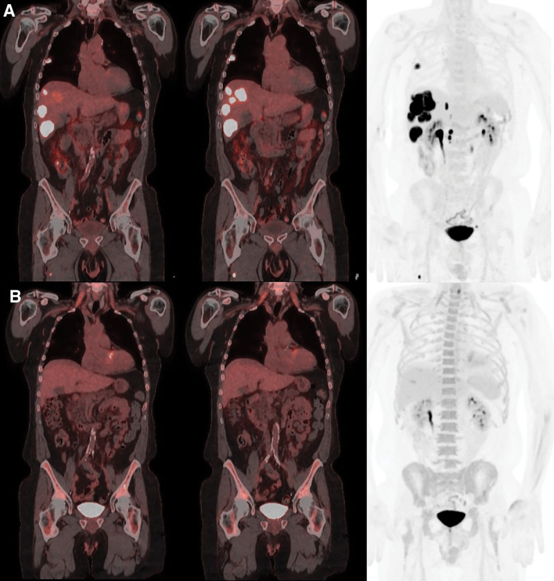 Complete response to chemoimmunotherapy with bevacizumab in synchronous multiple primary cancers: pulmonary adenocarcinoma and sarcomatoid carcinoma.