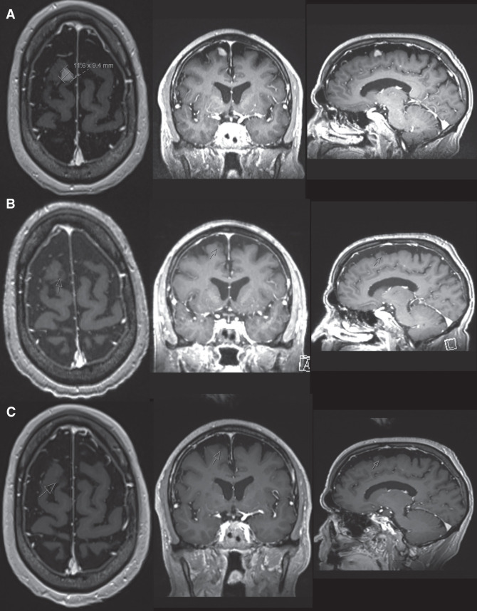 Complete response to chemoimmunotherapy with bevacizumab in synchronous multiple primary cancers: pulmonary adenocarcinoma and sarcomatoid carcinoma.