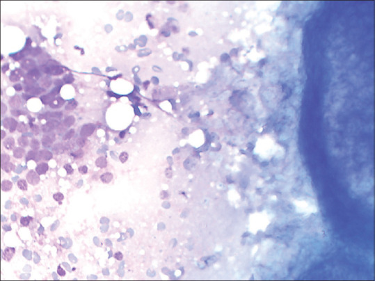 Cytological Diagnosis of Pilomatrixoma and its Diagnostic Pitfalls.