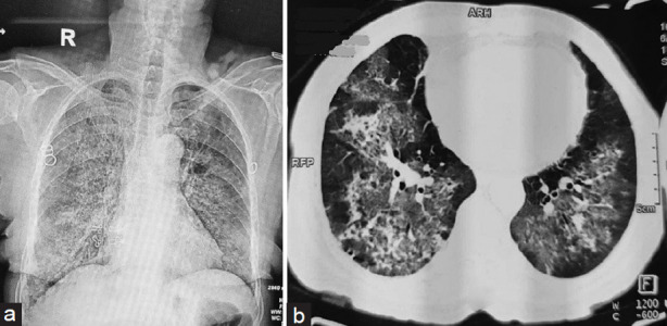 Pulmonary Tuberculosis Presenting as Diffuse Alveolar Hemorrhage.