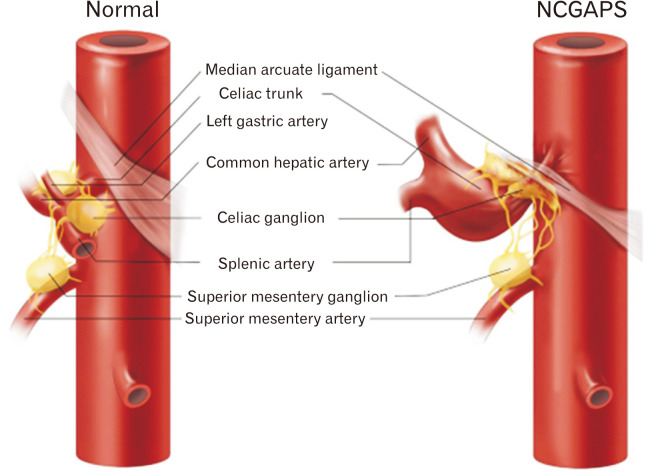 A Median Arcuate Ligament Syndrome Could Be Re-termed as a Nutcracker Celiac Ganglion Abdominal Pain Syndrome.