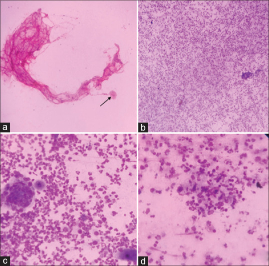 Cytological Diagnosis of Pilomatrixoma and its Diagnostic Pitfalls.