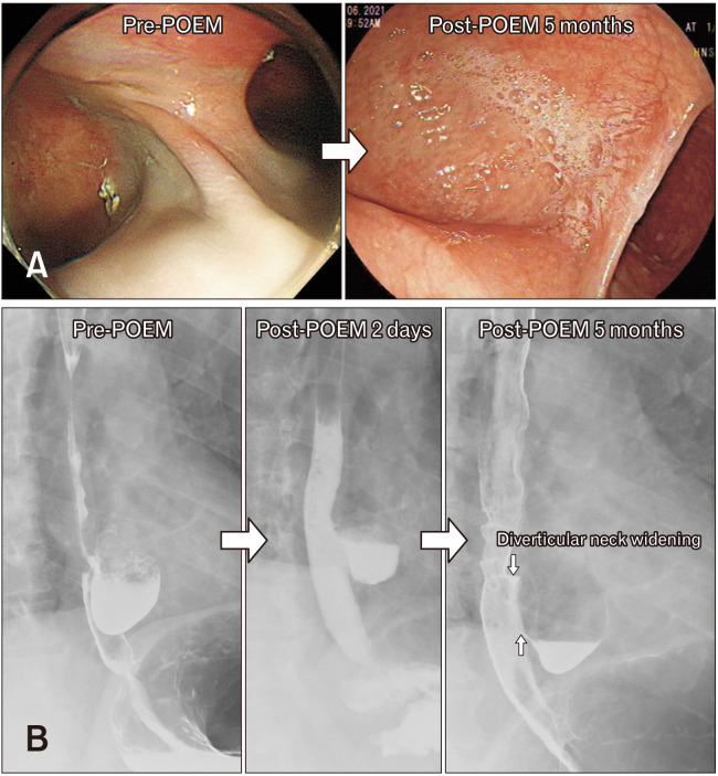 Usefulness of EndoFLIP in Diverticular Peroral Endoscopic Myotomy for Symptomatic Epiphrenic Diverticulum.