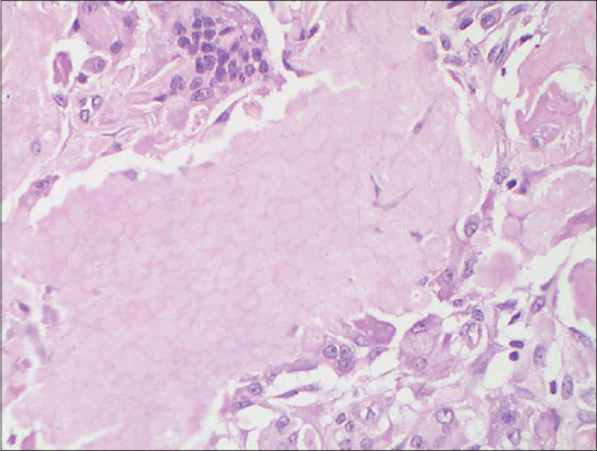 Cytological Diagnosis of Pilomatrixoma and its Diagnostic Pitfalls.