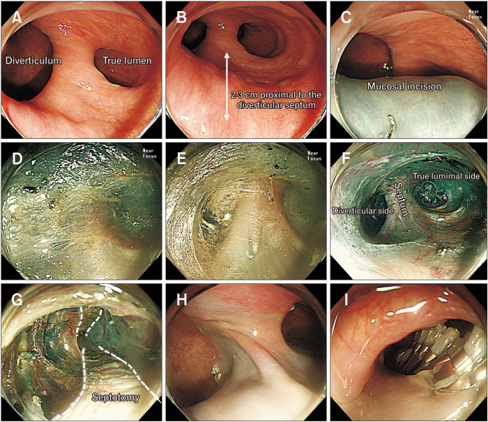 Usefulness of EndoFLIP in Diverticular Peroral Endoscopic Myotomy for Symptomatic Epiphrenic Diverticulum.