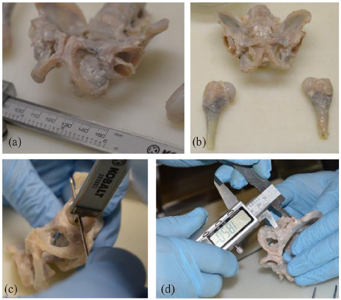 Femoral morphology in Ortolani's anatomical collection of developmental dysplasia of the hip: Anteversion is unrelated to severity of infantile dysplasia.