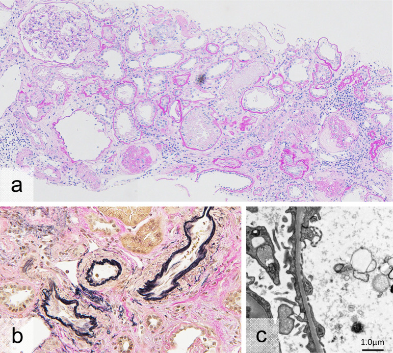 Case of hereditary kidney disease presenting thin basement membrane with a single heterozygous variant of Intersectin 2.