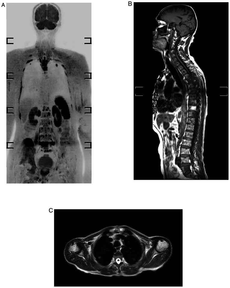 Whole‑body MRI for metastatic workup in patients diagnosed with cancer.