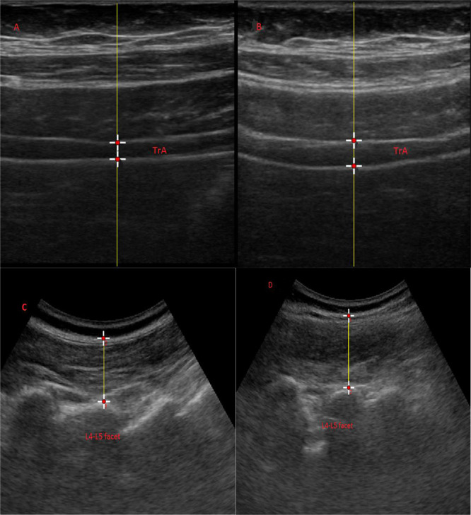 Reliability of Ultrasound Measurements of the Lumbar Multifidus and Transversus Abdominis Muscles during Lying and Unstable Sitting Positions in Individuals With and Without Chronic Low Back Pain.