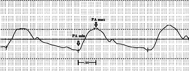 Importance of the Mean Rate of Pressure Change of the Pulmonary Artery (dP/dt mean PA) in Patients with Pulmonary Arterial Hypertension.