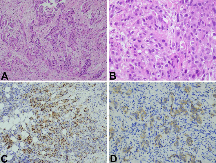 BRCA gene amplification in primary peritoneal high-grade serous carcinoma patient with intrinsic resistance to platinum treatment: a case report.