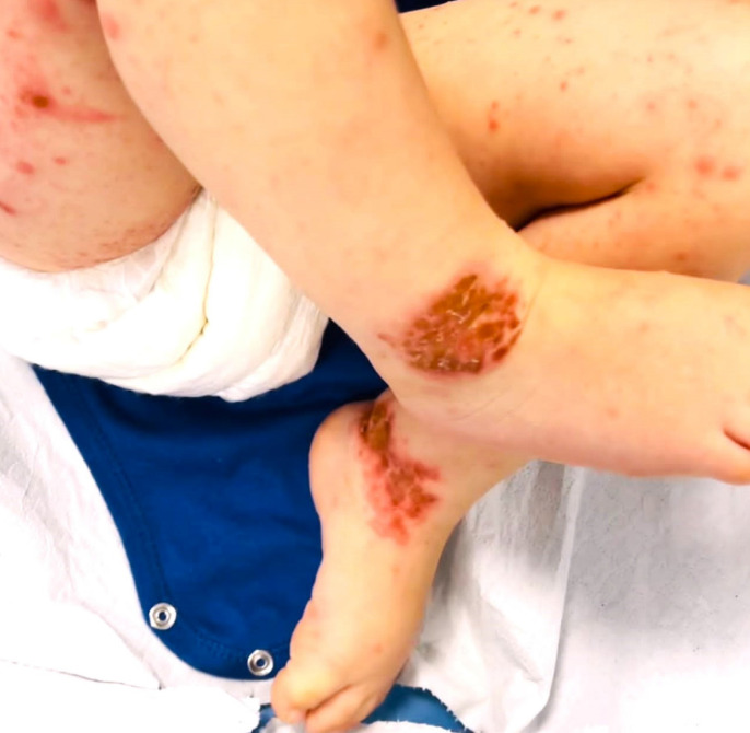 Disseminated life-threatening viral skin rash in a child with atopic dermatitis.