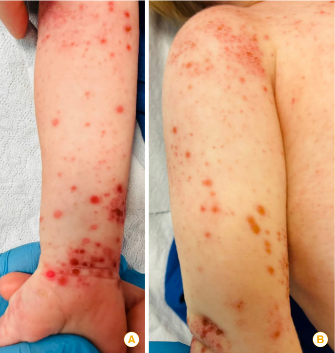 Disseminated life-threatening viral skin rash in a child with atopic dermatitis.