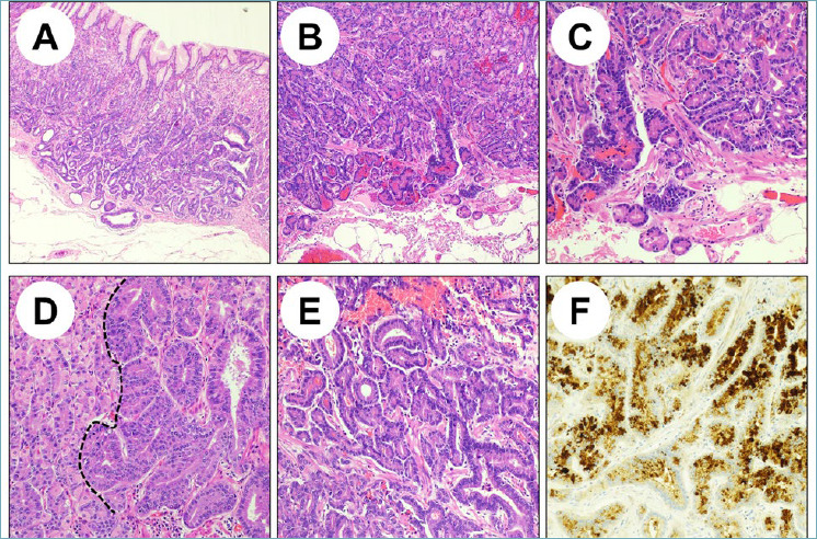 Preoperative endoscopy and pathology report of the specimen to be recommended in sleeve gastrectomy?