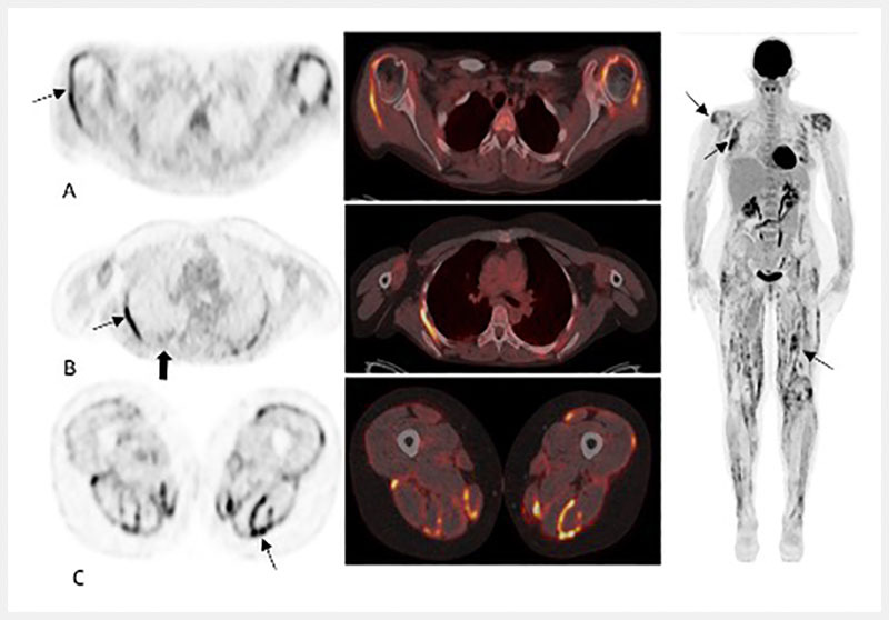 F18-FDG PET/CT in a patient with Antisynthetase Syndrome.