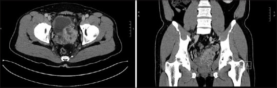 Seminal vesicle metastasis from hepatocellular carcinoma and renal cell carcinoma.