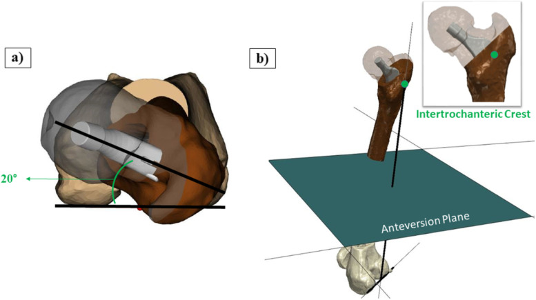 Guiding prosthetic femoral version using 3D-printed patient-specific instrumentation (PSI): a pilot study.