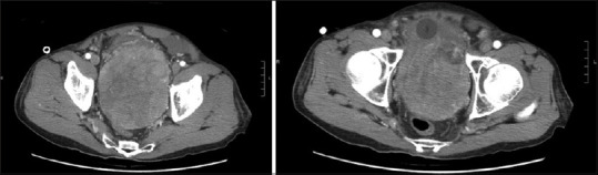 Seminal vesicle metastasis from hepatocellular carcinoma and renal cell carcinoma.