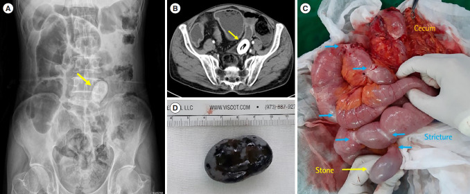 An oval-shaped calcification in Crohn's disease patient with mechanical ileus.