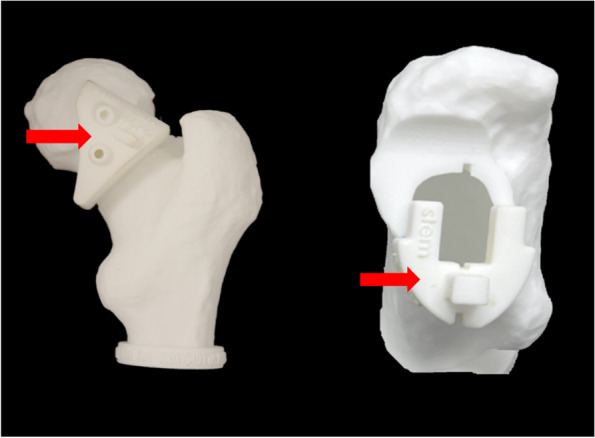 Guiding prosthetic femoral version using 3D-printed patient-specific instrumentation (PSI): a pilot study.