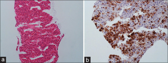 Seminal vesicle metastasis from hepatocellular carcinoma and renal cell carcinoma.