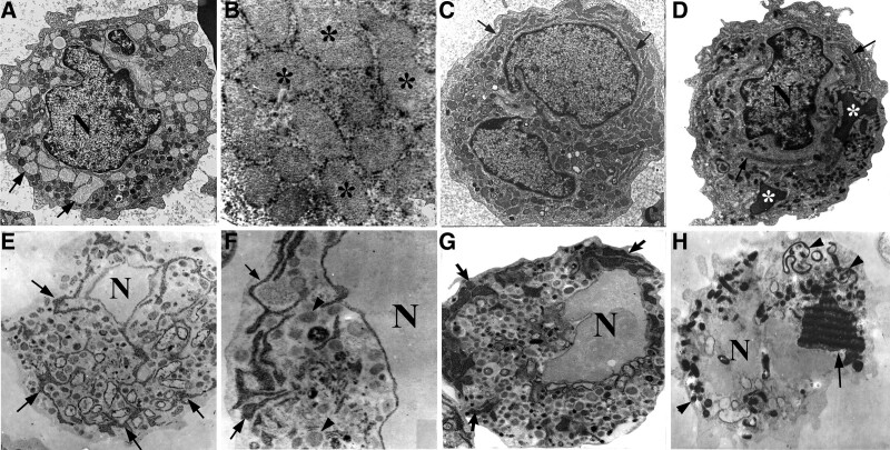 Development of Auer bodies from giant inclusions associated with rough endoplasmic reticulum in acute promyelocytic leukemia.