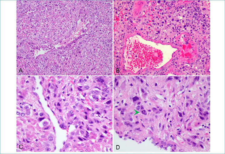 Placental site trophoblastic tumor (PSTT): a case report and review of the literature.