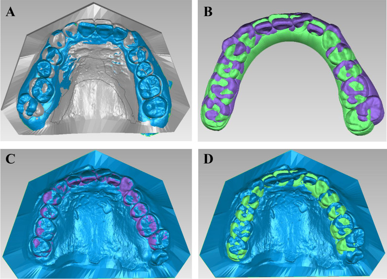 Effectiveness of clear aligners in achieving proclination and intrusion of incisors among Class II division 2 patients: a multivariate analysis.