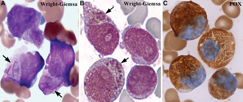 Development of Auer bodies from giant inclusions associated with rough endoplasmic reticulum in acute promyelocytic leukemia.