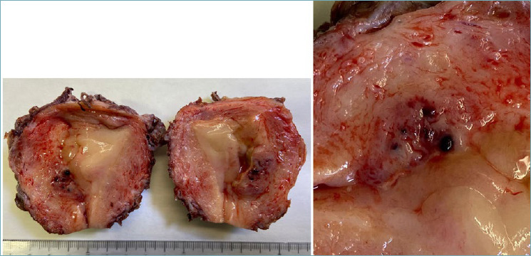 Placental site trophoblastic tumor (PSTT): a case report and review of the literature.