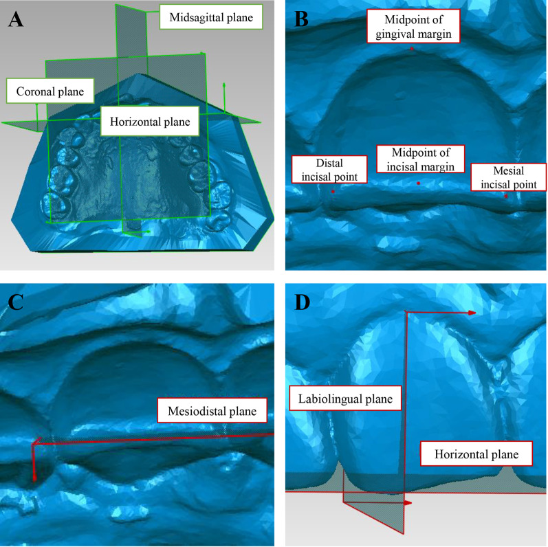 Effectiveness of clear aligners in achieving proclination and intrusion of incisors among Class II division 2 patients: a multivariate analysis.