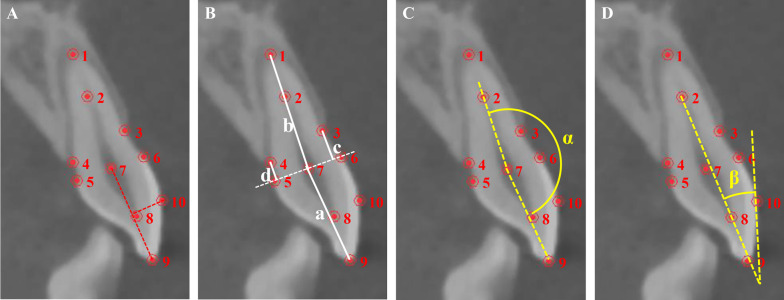 Effectiveness of clear aligners in achieving proclination and intrusion of incisors among Class II division 2 patients: a multivariate analysis.