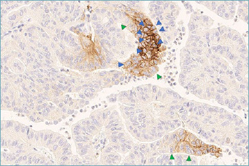 A practical approach for PD-L1 evaluation in gastroesophageal cancer.