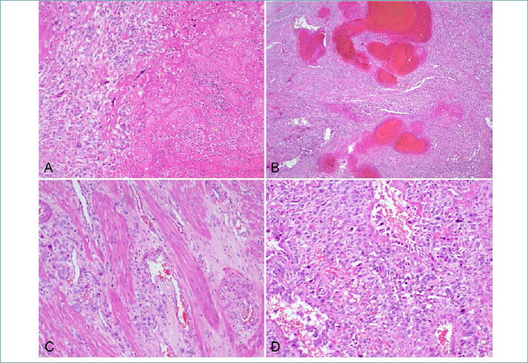 Placental site trophoblastic tumor (PSTT): a case report and review of the literature.