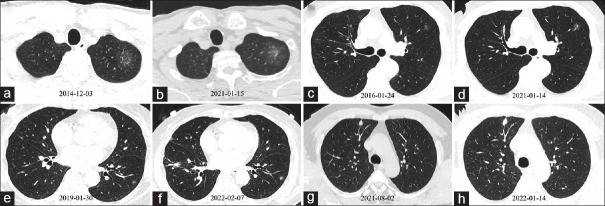 Management of pulmonary nodules in women with pregnant intention: A review with perspective.