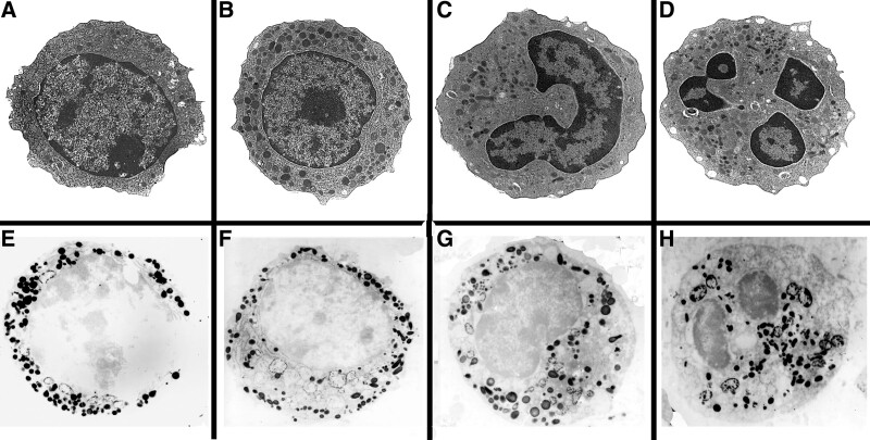 Development of Auer bodies from giant inclusions associated with rough endoplasmic reticulum in acute promyelocytic leukemia.