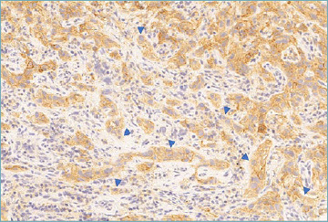 A practical approach for PD-L1 evaluation in gastroesophageal cancer.