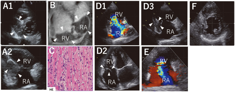 Tendon Cord Rupture of Tricuspid Valve During Chemotherapy for Primary Cardiac Diffuse Large B-Cell Lymphoma.