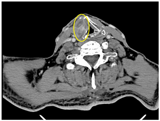 [Multiple myeloma with laryngeal affectation: an uncommon cause of dysphonia].