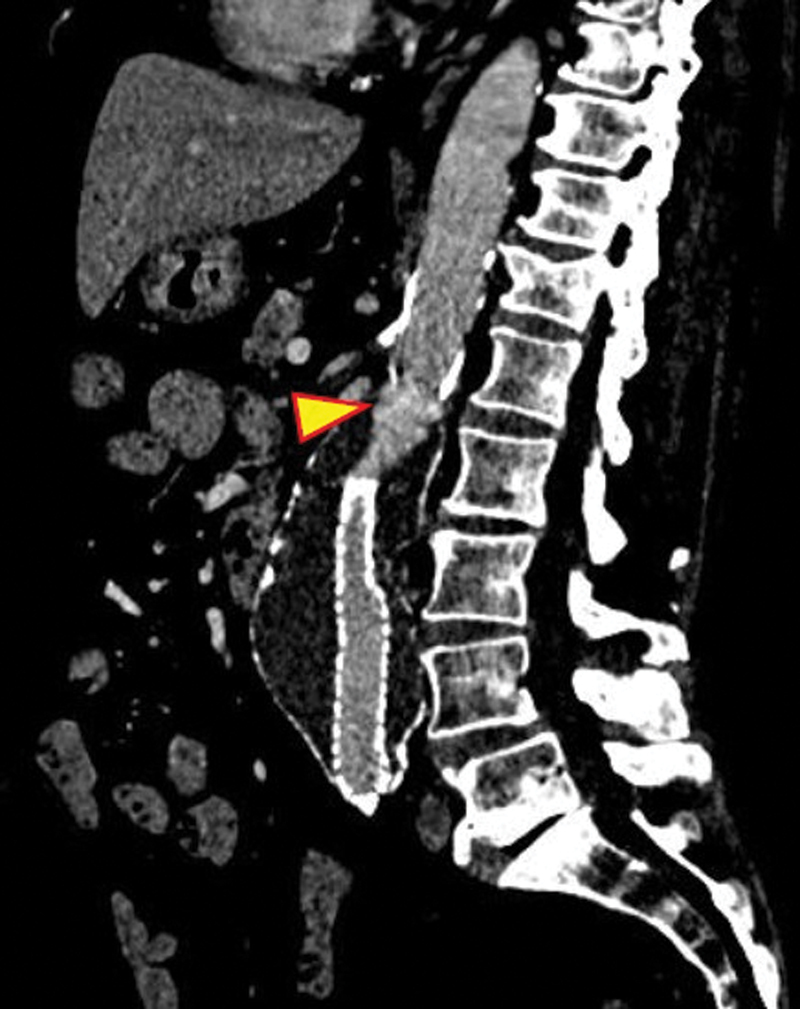 Technical Characteristics of the Ovation Alto for the Treatment of Abdominal Aortic Aneurysms: Application to Challenging Anatomies.