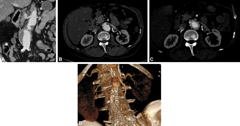 Technical Characteristics of the Ovation Alto for the Treatment of Abdominal Aortic Aneurysms: Application to Challenging Anatomies.