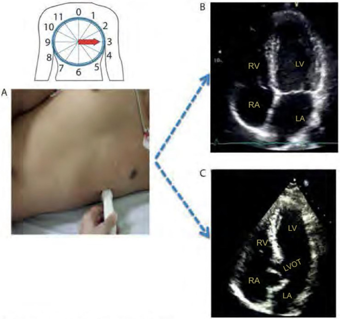 The use of bedside echocardiography in the care of critically ill patients - a joint consensus document of the Associação de Medicina Intensiva Brasileira, Associação Brasileira de Medicina de Emergência and Sociedade Brasileira de Medicina Hospitalar. Part 2 - Technical aspects.