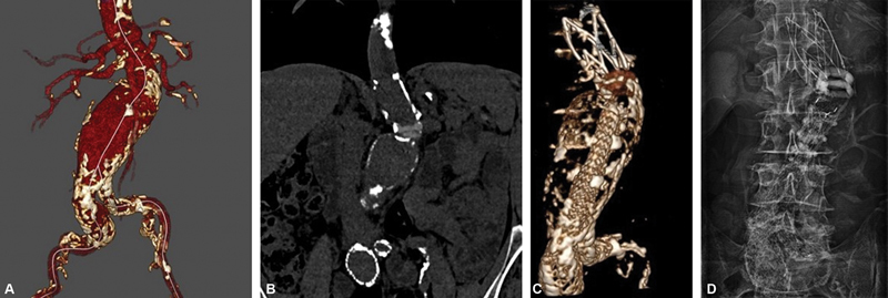 Technical Characteristics of the Ovation Alto for the Treatment of Abdominal Aortic Aneurysms: Application to Challenging Anatomies.