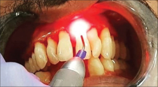 Rehabilitation and follow up of a Case of Periodontitis - Generalized, Stage IV, Grade B, Progressive, and with no Risk Factors.