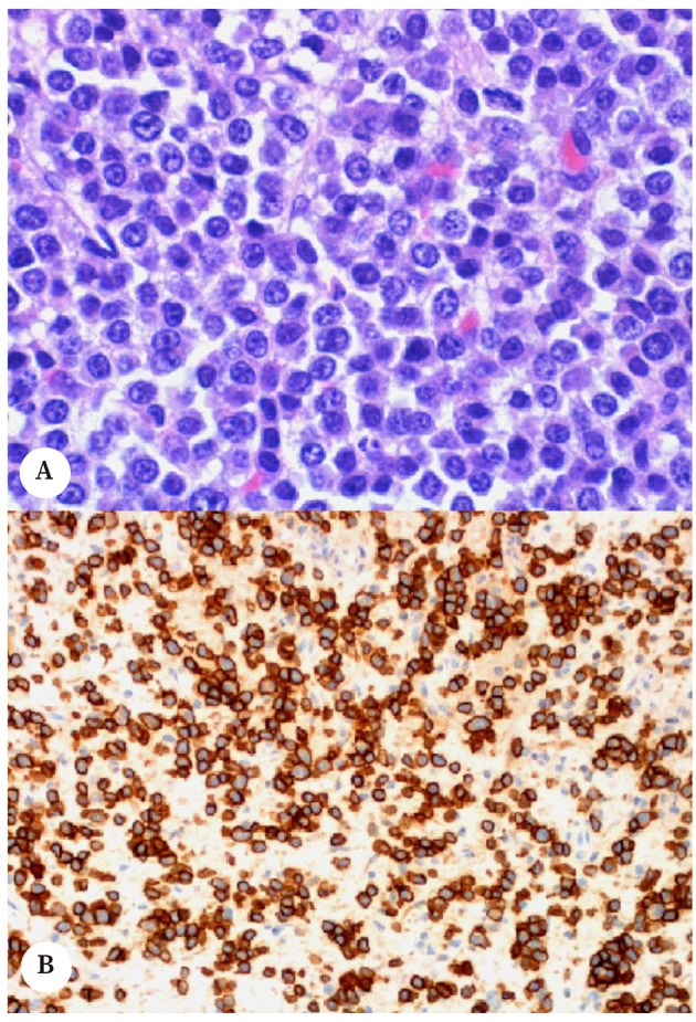 [Multiple myeloma with laryngeal affectation: an uncommon cause of dysphonia].