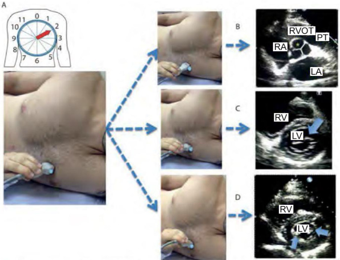 The use of bedside echocardiography in the care of critically ill patients - a joint consensus document of the Associação de Medicina Intensiva Brasileira, Associação Brasileira de Medicina de Emergência and Sociedade Brasileira de Medicina Hospitalar. Part 2 - Technical aspects.