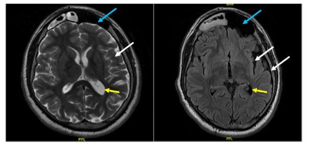 Presentation of Dyke-Davidoff-Masson Syndrome in adult male.